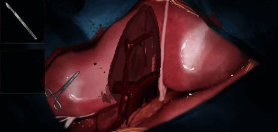 《水鬼》手术环节截图
